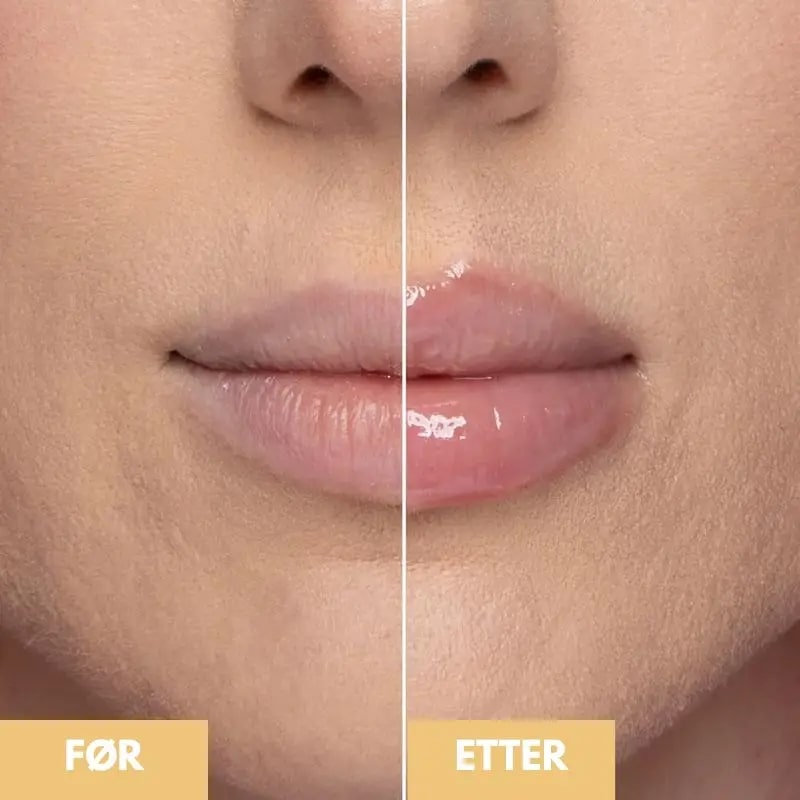 Lips Plumper