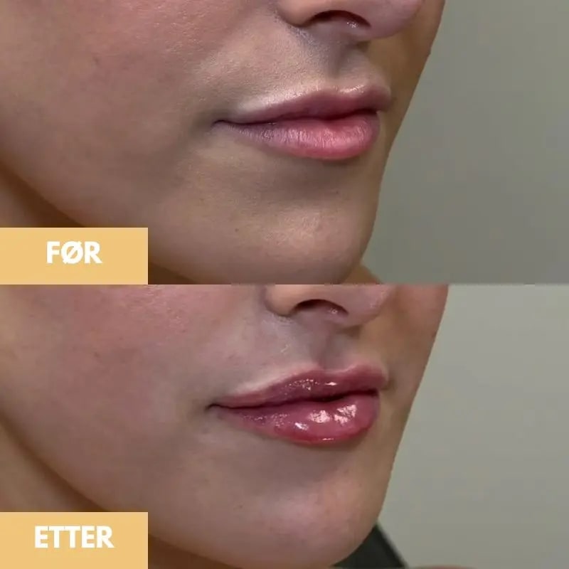 Lips Plumper