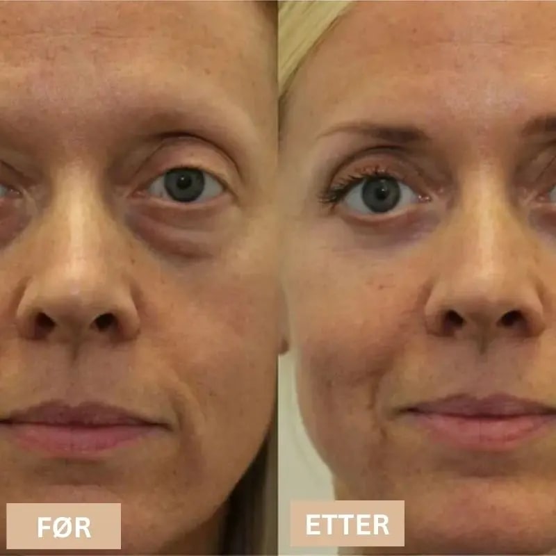 Dark Circles and Firming Cream med rødt lys